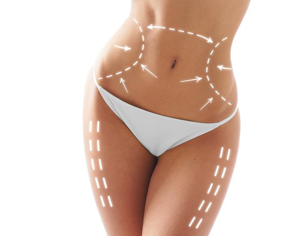 Cryolipolysis